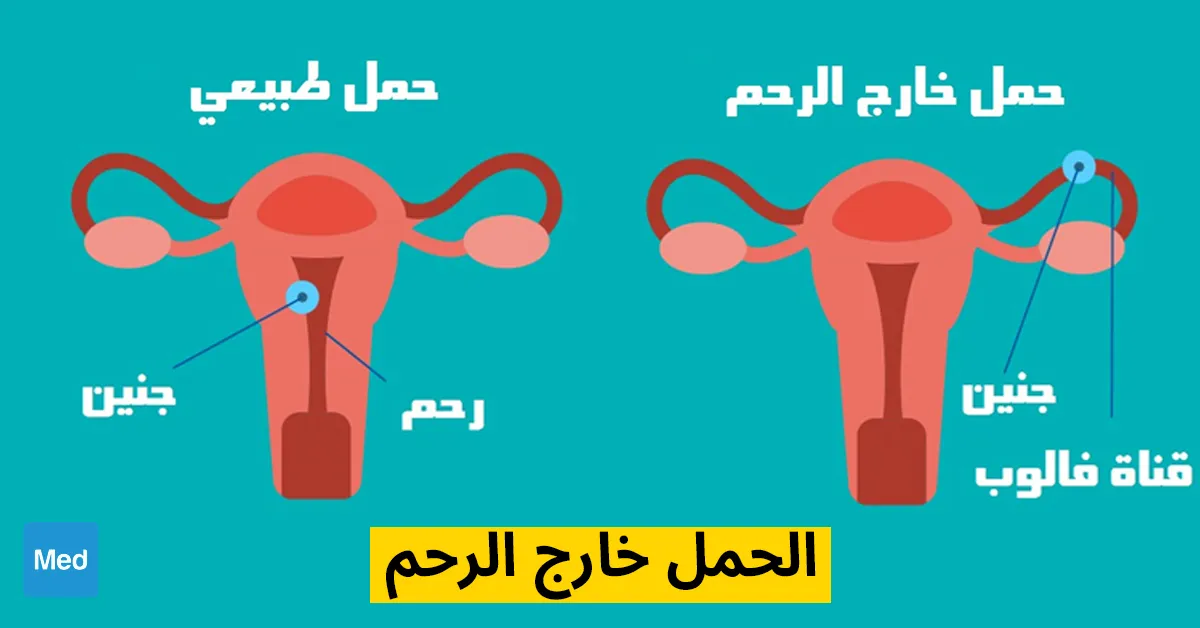 الحمل خارج الرحم